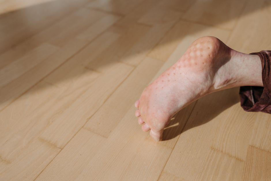 꽉 끼는 신발로 변형된 발의 모습